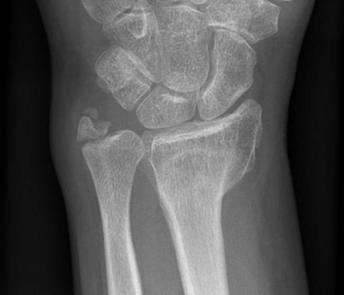 Radial Maluion Loss Radial Inclination